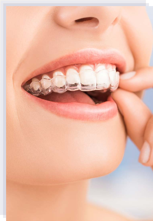 Clear Braces: The Discreet Solution for a Beautiful Smile